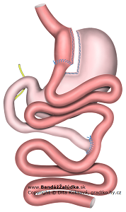 Schéma gastrického bypasu Roux Y