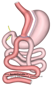 Schéma Omega gastrického bypasu