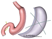 Tubulizácia žalúdka